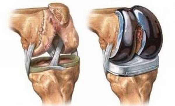 Полиартрит сустава колена